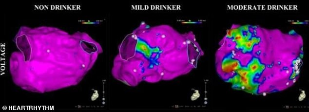 Shocking scans reveal how regular alcohol consumption can lead to an irregular heartbeat